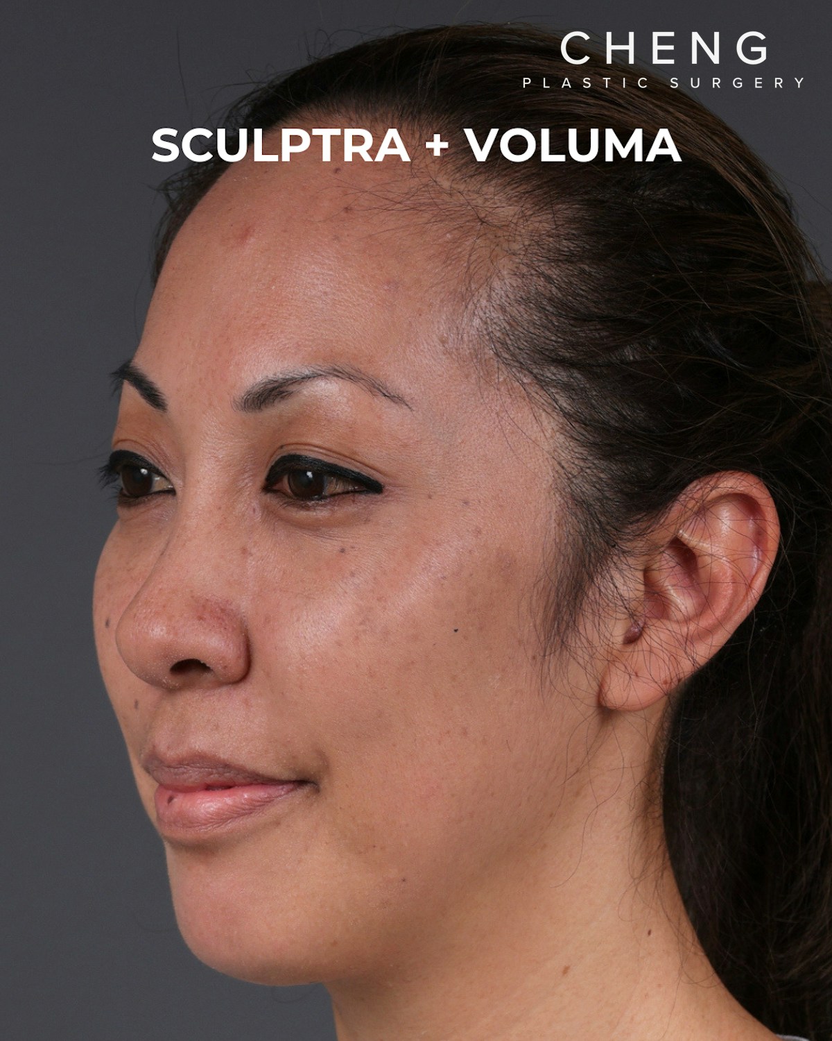 Dermal Fillers Before & After Gallery - Patient 172558 - Image 6