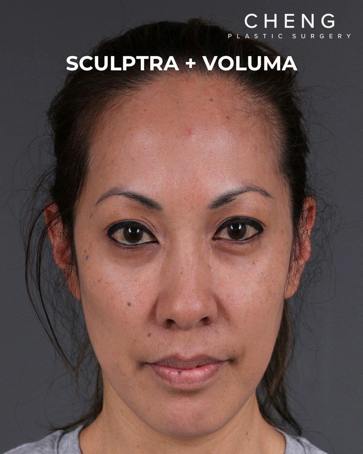 Dermal Fillers Before & After Gallery - Patient 172558 - Image 2