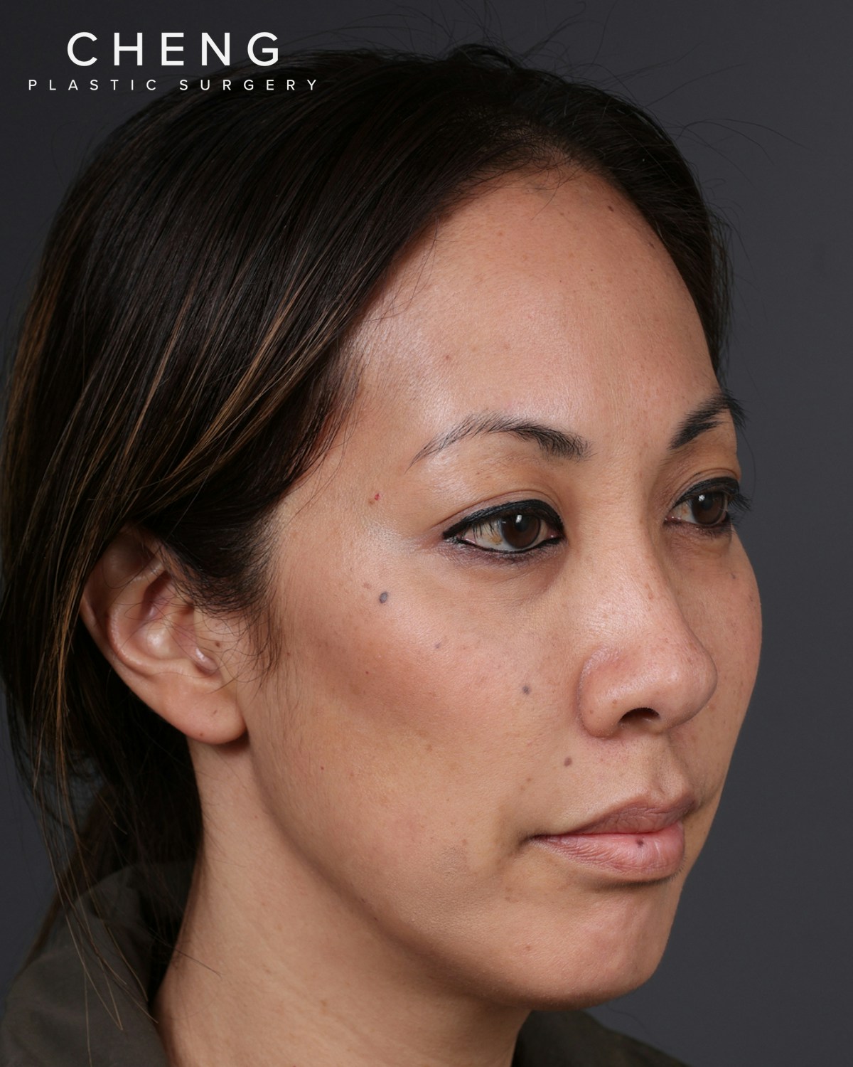Dermal Fillers Before & After Gallery - Patient 172558 - Image 3