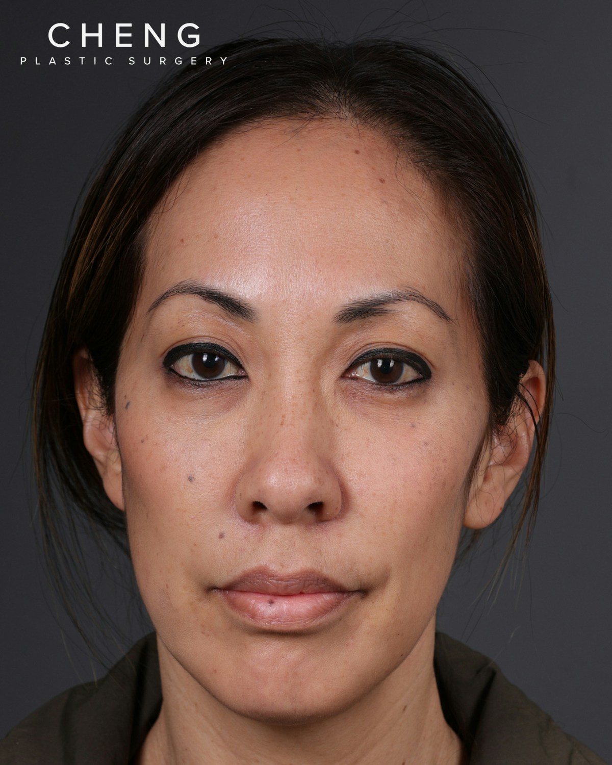Dermal Fillers Before & After Gallery - Patient 172558 - Image 1