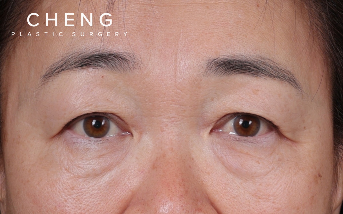 Fat Grafting Before & After Gallery - Patient 198306 - Image 1