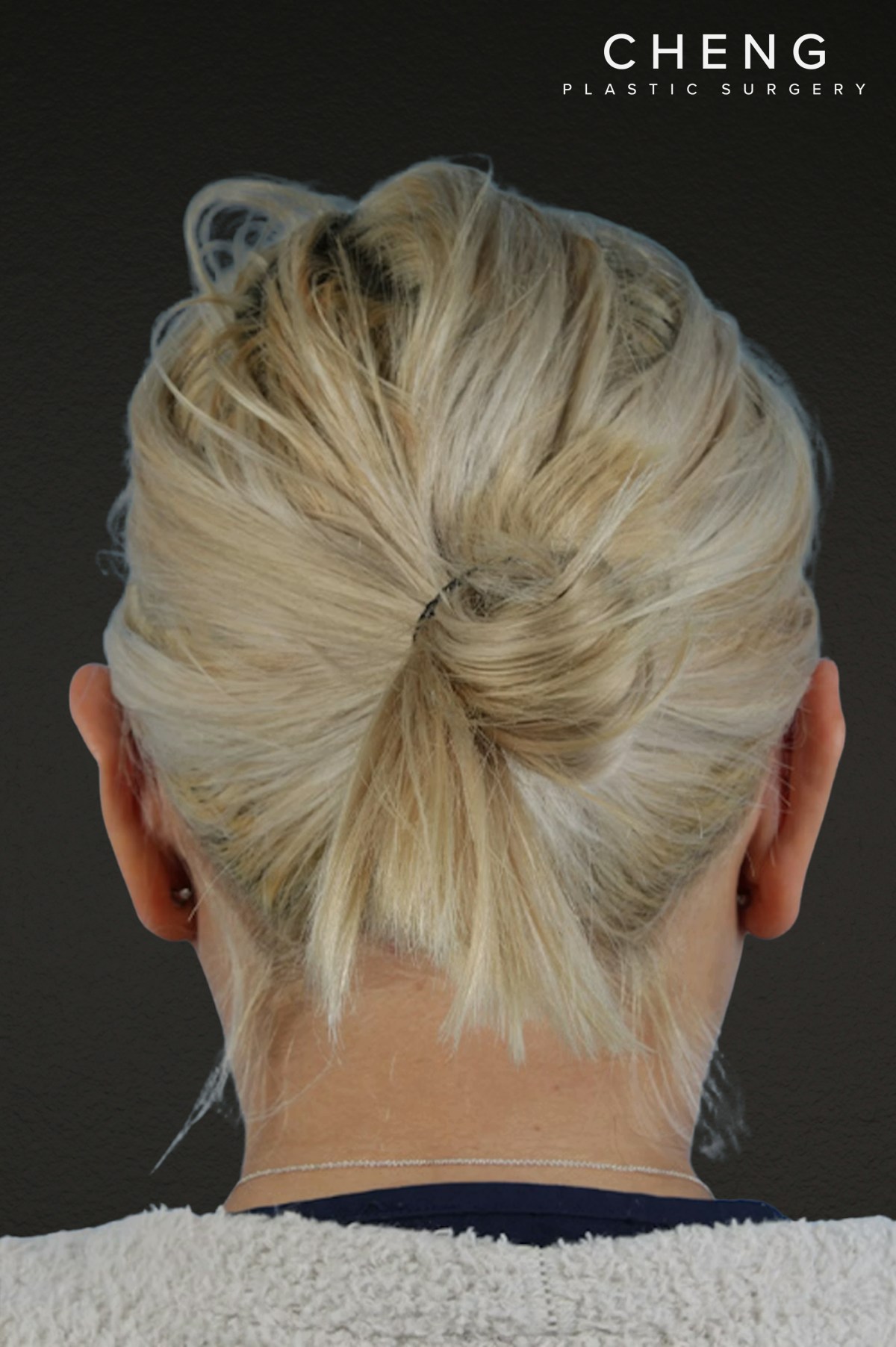 Otoplasty Before & After Gallery - Patient 302523 - Image 2