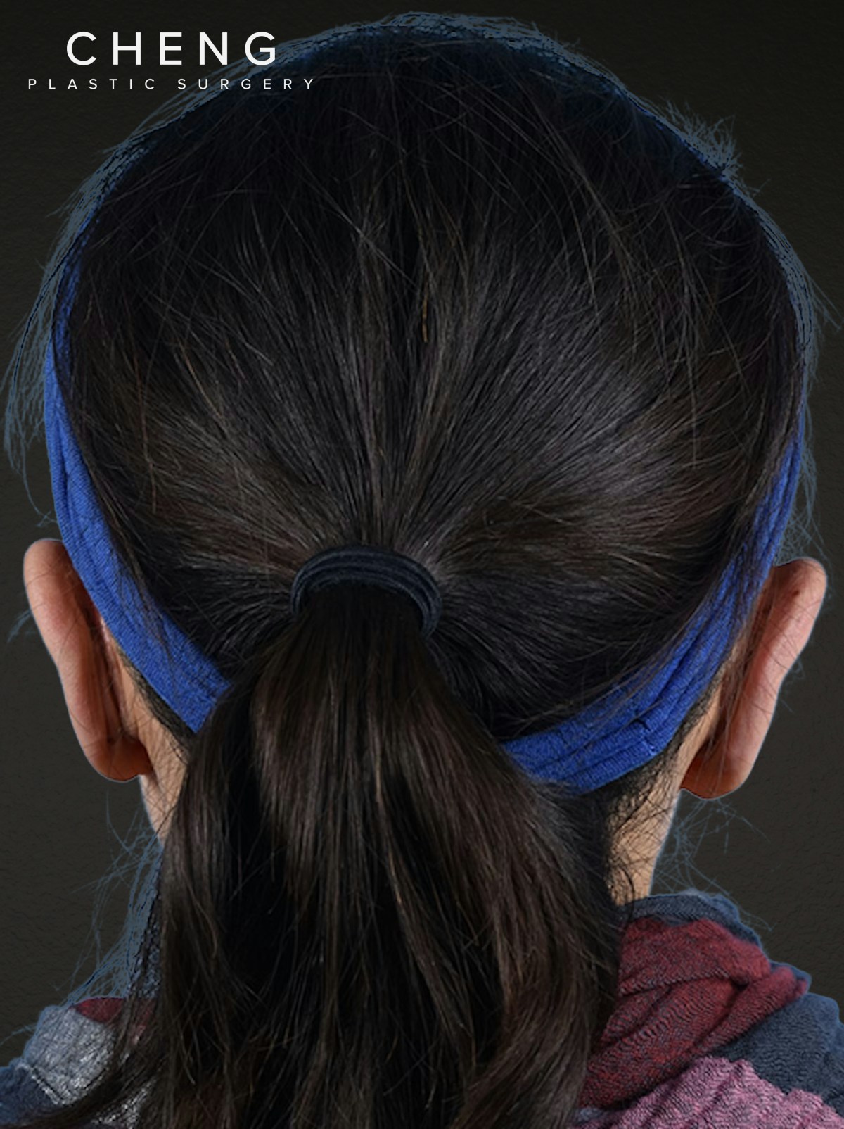 Otoplasty Before & After Gallery - Patient 260468 - Image 1