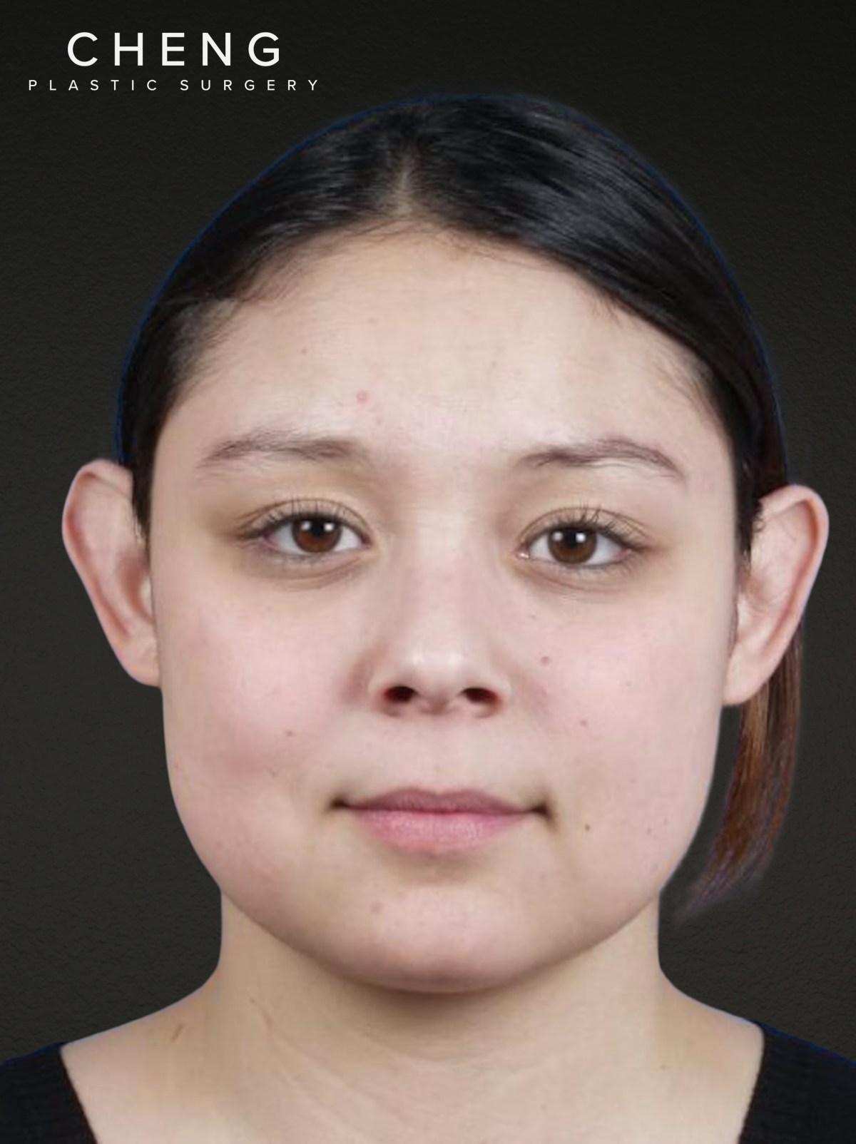 Otoplasty Before & After Gallery - Patient 316708 - Image 1