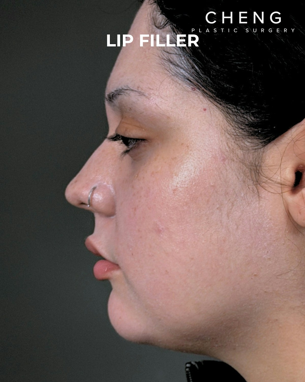 Dermal Fillers Before & After Gallery - Patient 203654 - Image 6