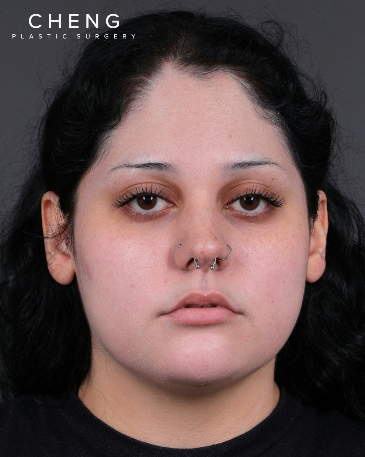 Dermal Fillers Before & After Gallery - Patient 203654 - Image 1