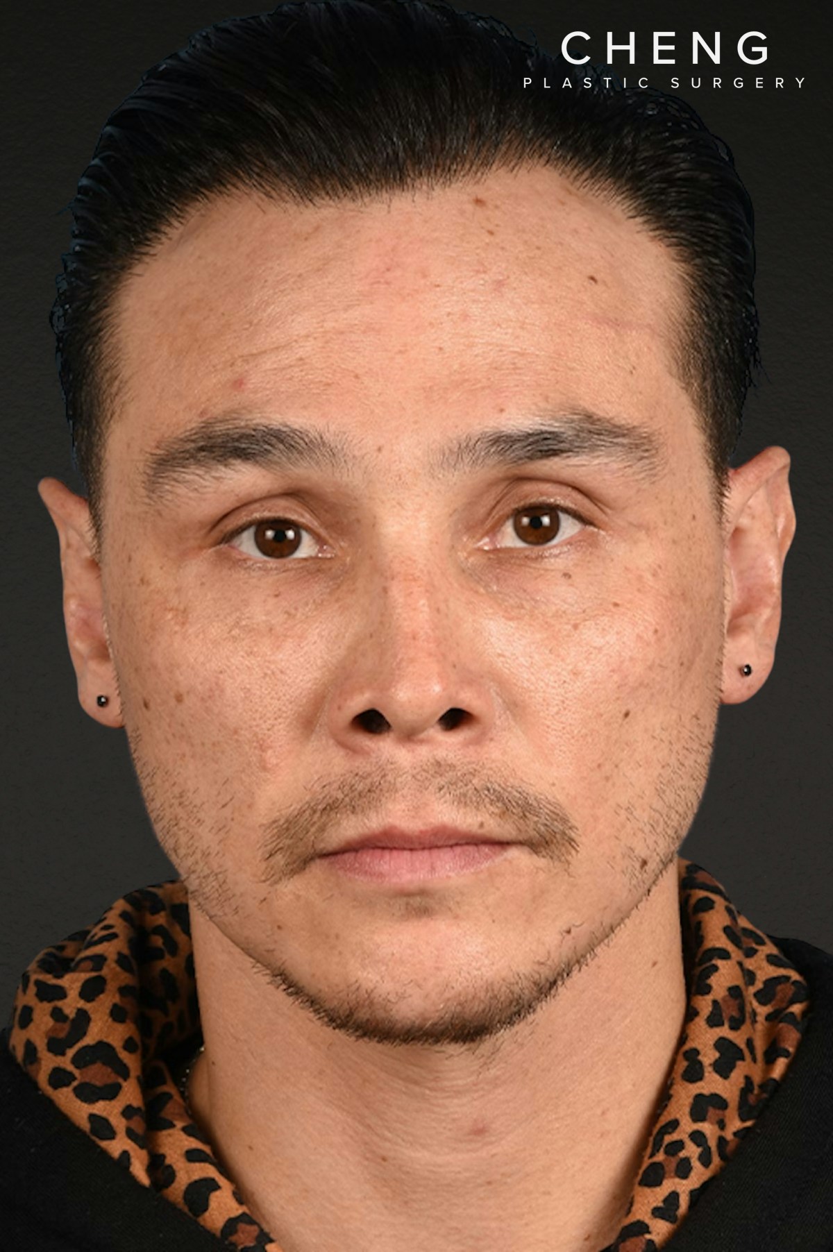 Hair Transplant With NeoGraft Before & After Gallery - Patient 494446 - Image 2