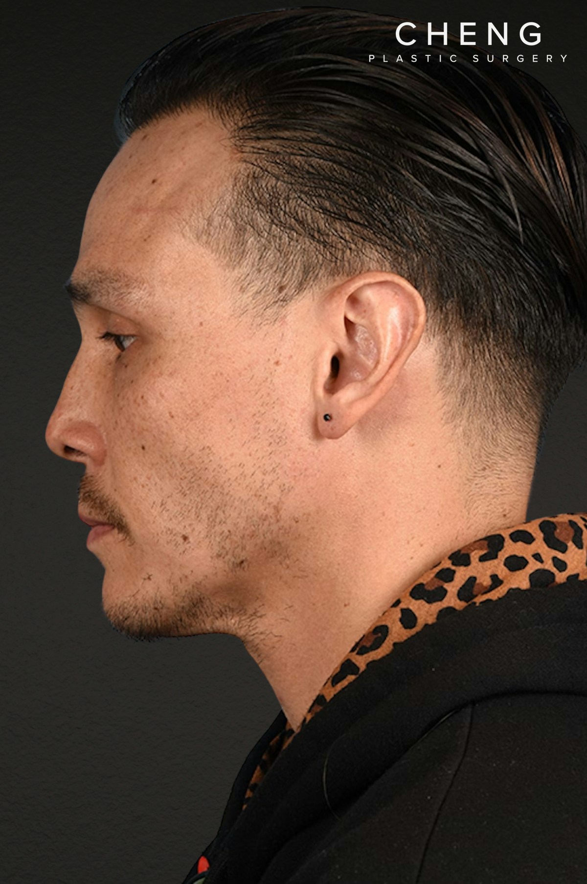 Hair Transplant With NeoGraft Before & After Gallery - Patient 494446 - Image 4