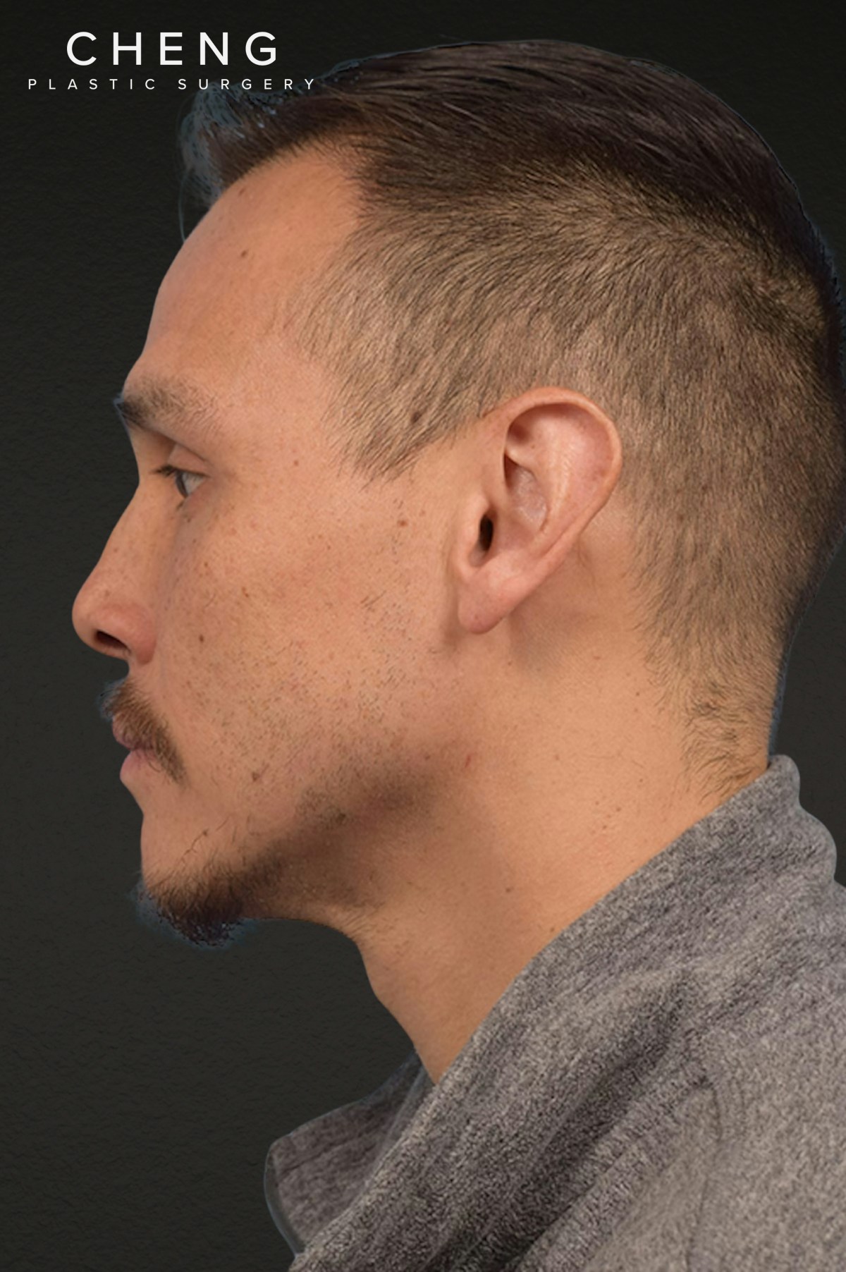 Hair Transplant With NeoGraft Before & After Gallery - Patient 494446 - Image 3