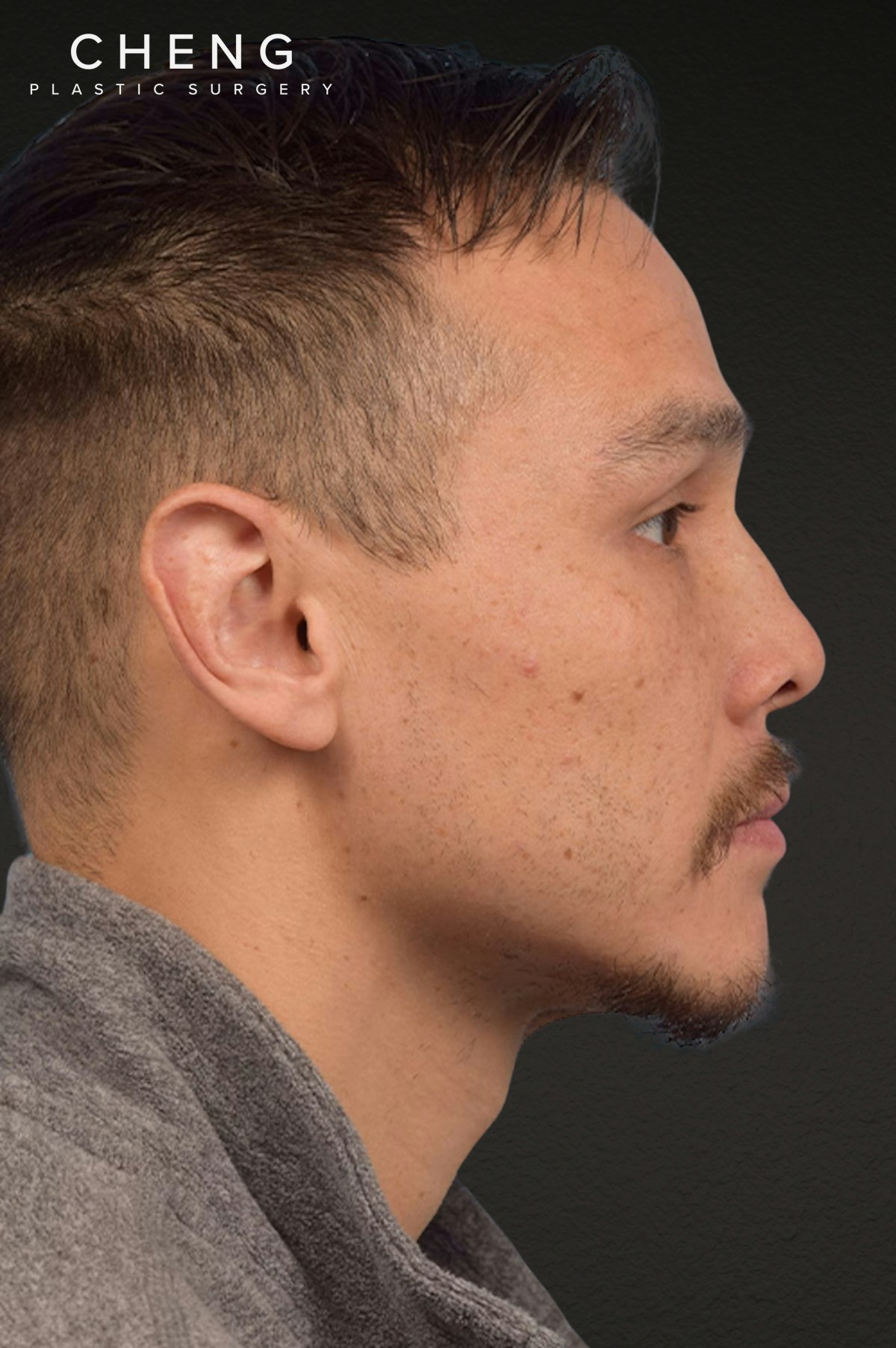 Hair Transplant With NeoGraft Before & After Gallery - Patient 494446 - Image 5
