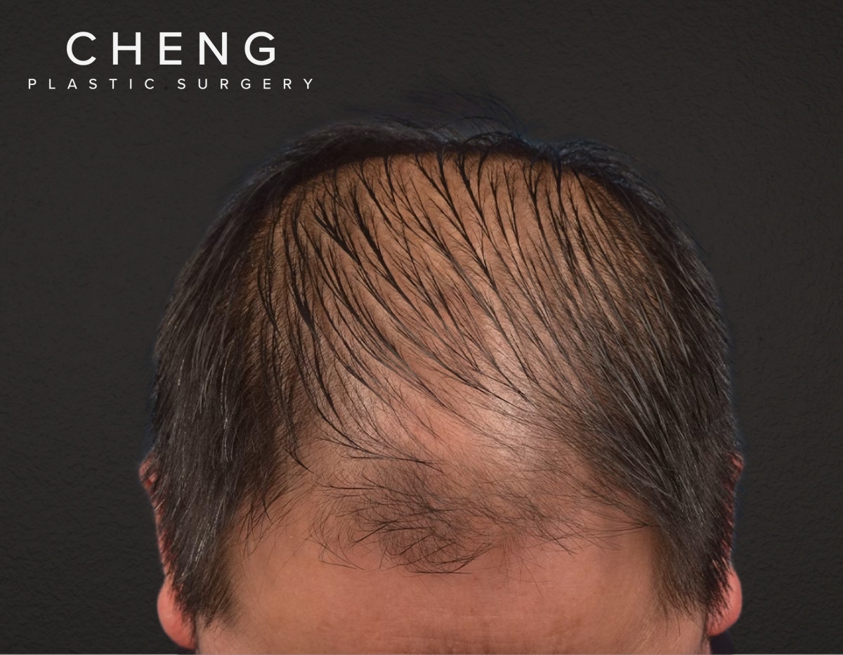 Hair Transplant With NeoGraft Before & After Gallery - Patient 242971 - Image 1