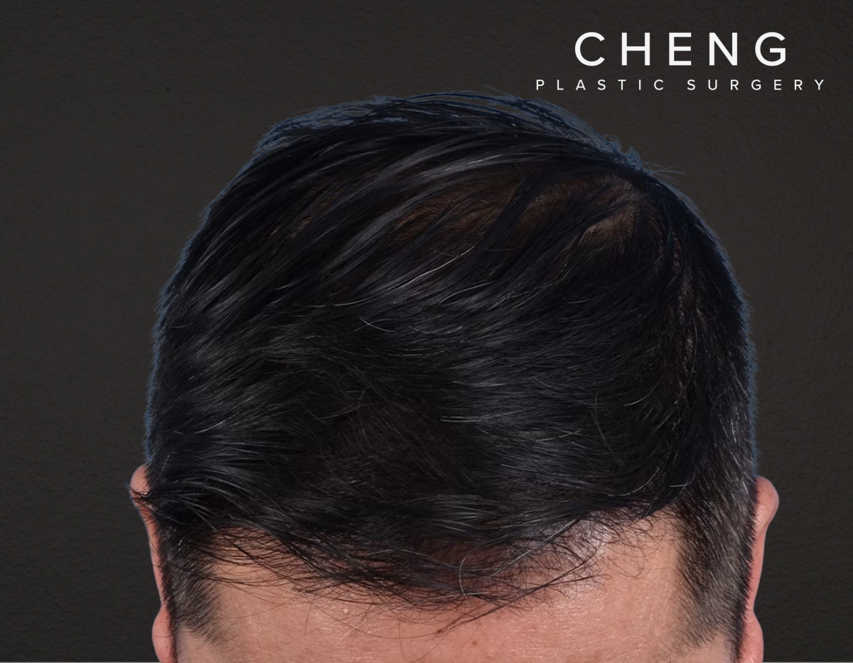 Hair Transplant With NeoGraft Before & After Gallery - Patient 242971 - Image 2