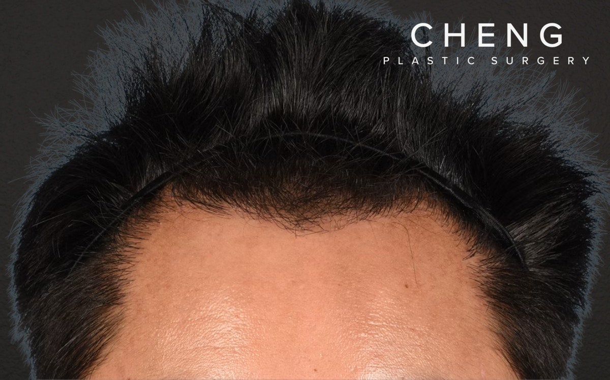 Hair Transplant With NeoGraft Before & After Gallery - Patient 421962 - Image 2