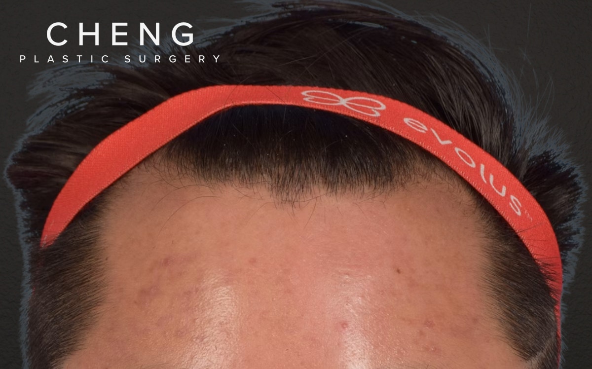 Hair Transplant With NeoGraft Before & After Gallery - Patient 421962 - Image 1