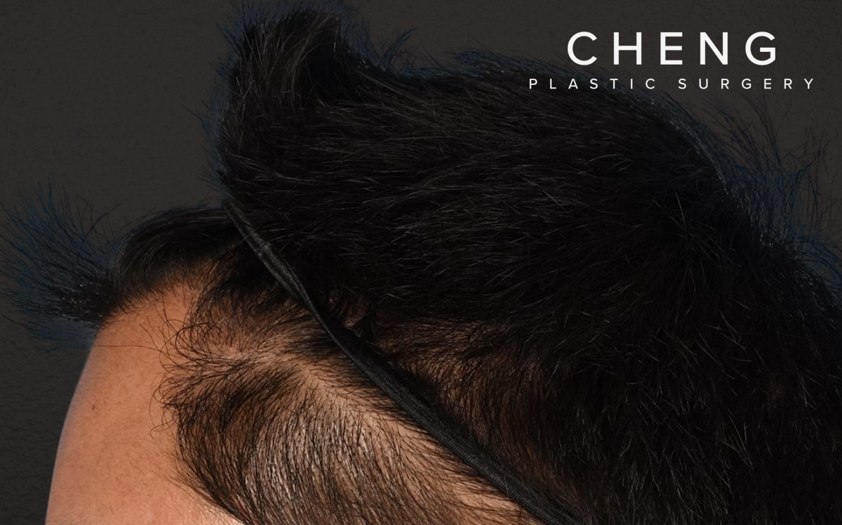 Hair Transplant With NeoGraft Before & After Gallery - Patient 421962 - Image 6