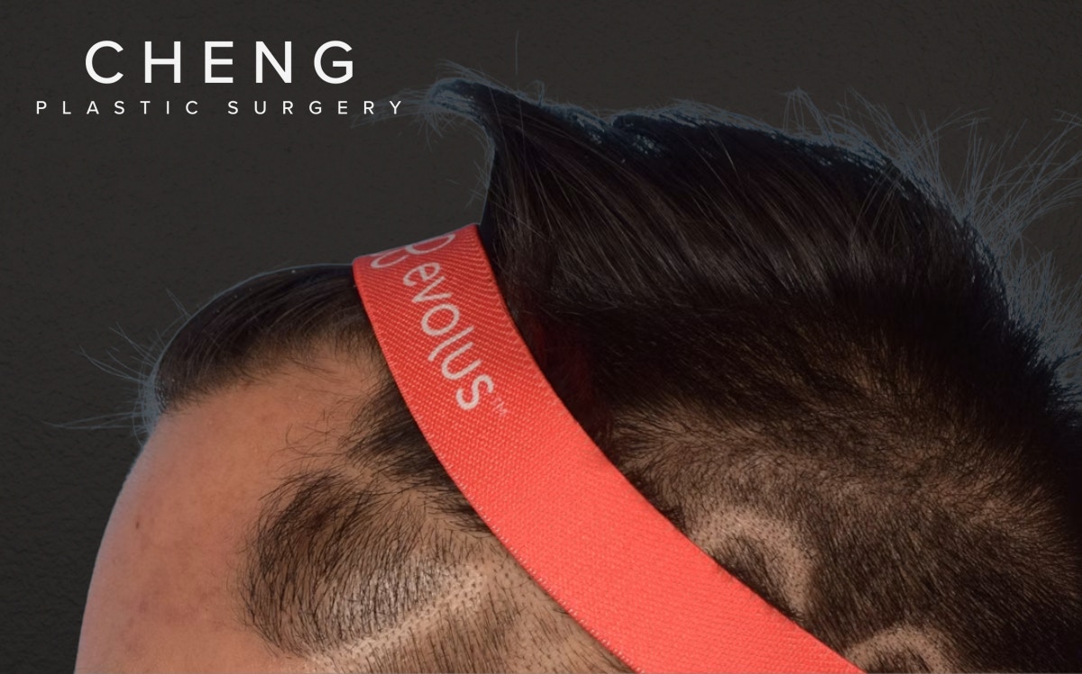 Hair Transplant With NeoGraft Before & After Gallery - Patient 421962 - Image 5