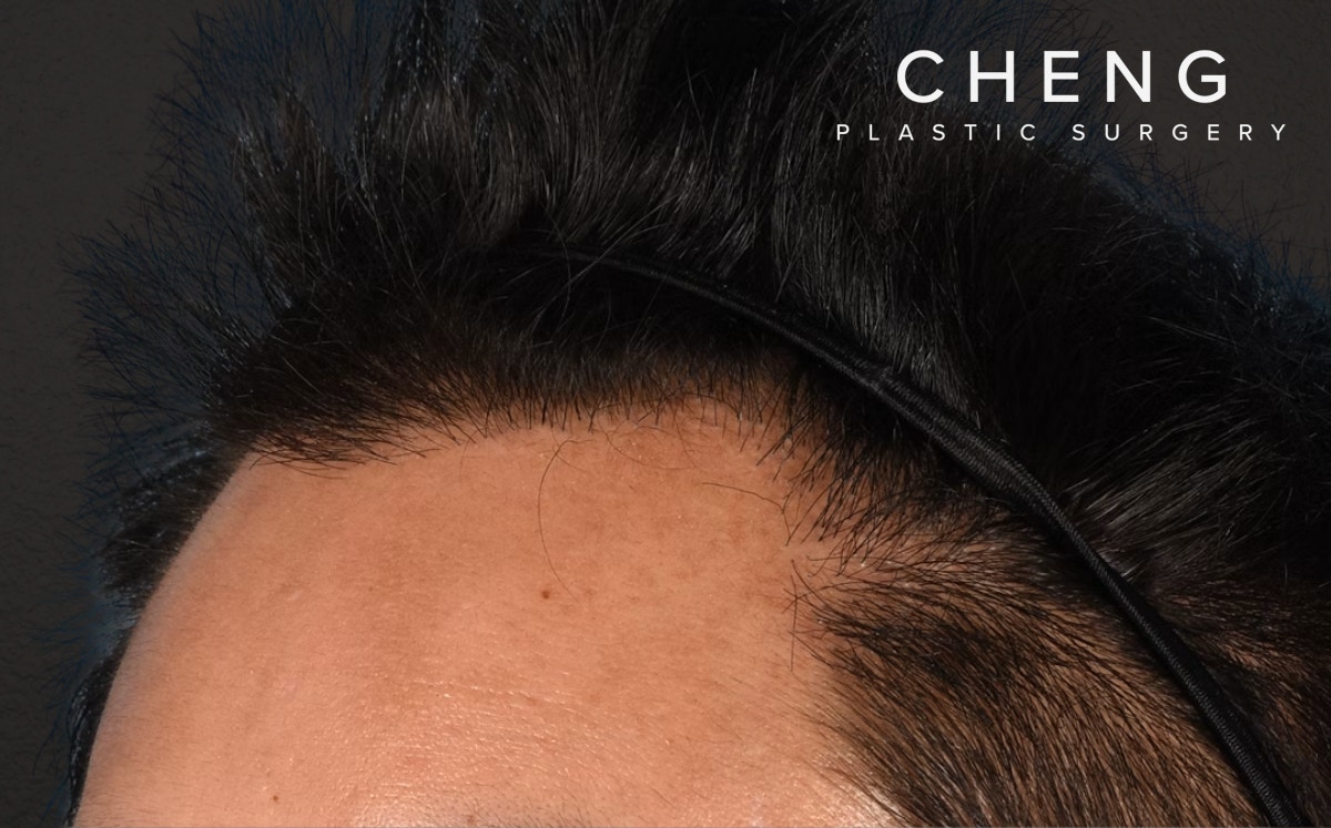 Hair Transplant With NeoGraft Before & After Gallery - Patient 421962 - Image 8