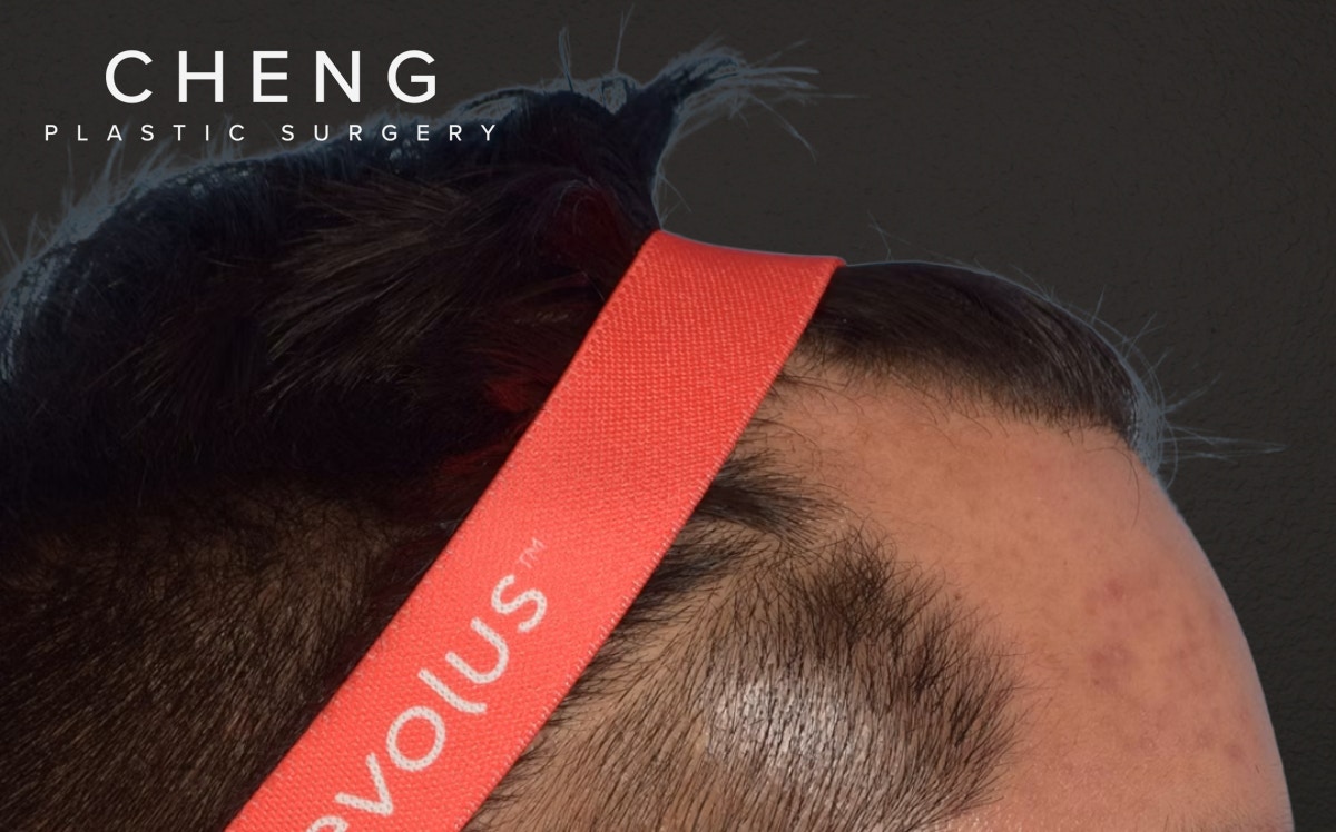 Hair Transplant With NeoGraft Before & After Gallery - Patient 421962 - Image 9