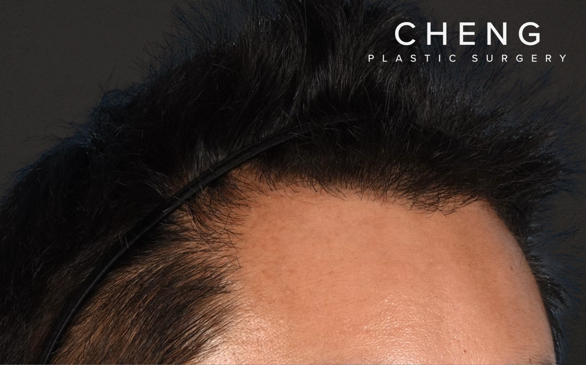 Hair Transplant With NeoGraft Before & After Gallery - Patient 421962 - Image 4