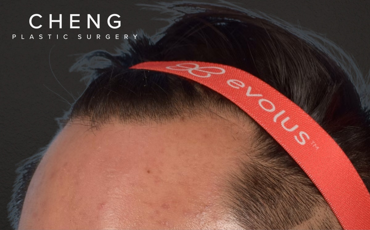 Hair Transplant With NeoGraft Before & After Gallery - Patient 421962 - Image 7