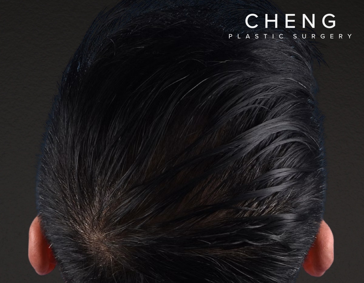 Hair Transplant With NeoGraft Before & After Gallery - Patient 242971 - Image 4