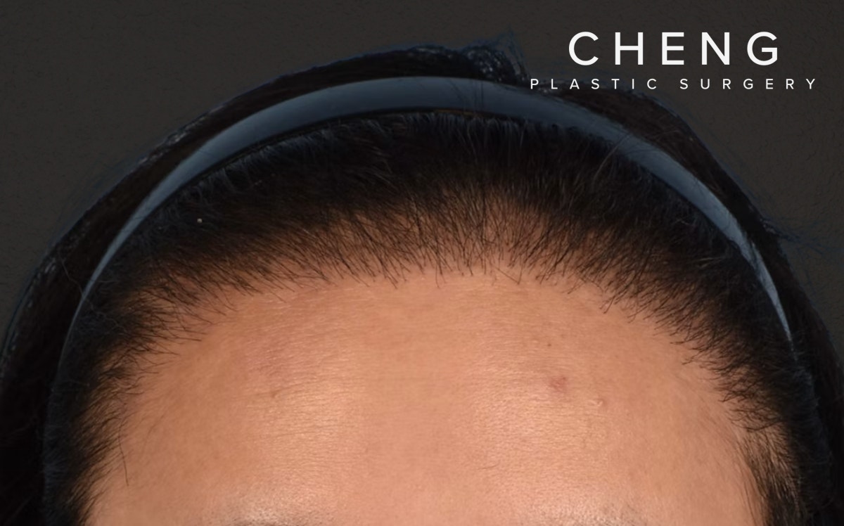 Hair Transplant With NeoGraft Before & After Gallery - Patient 984625 - Image 2