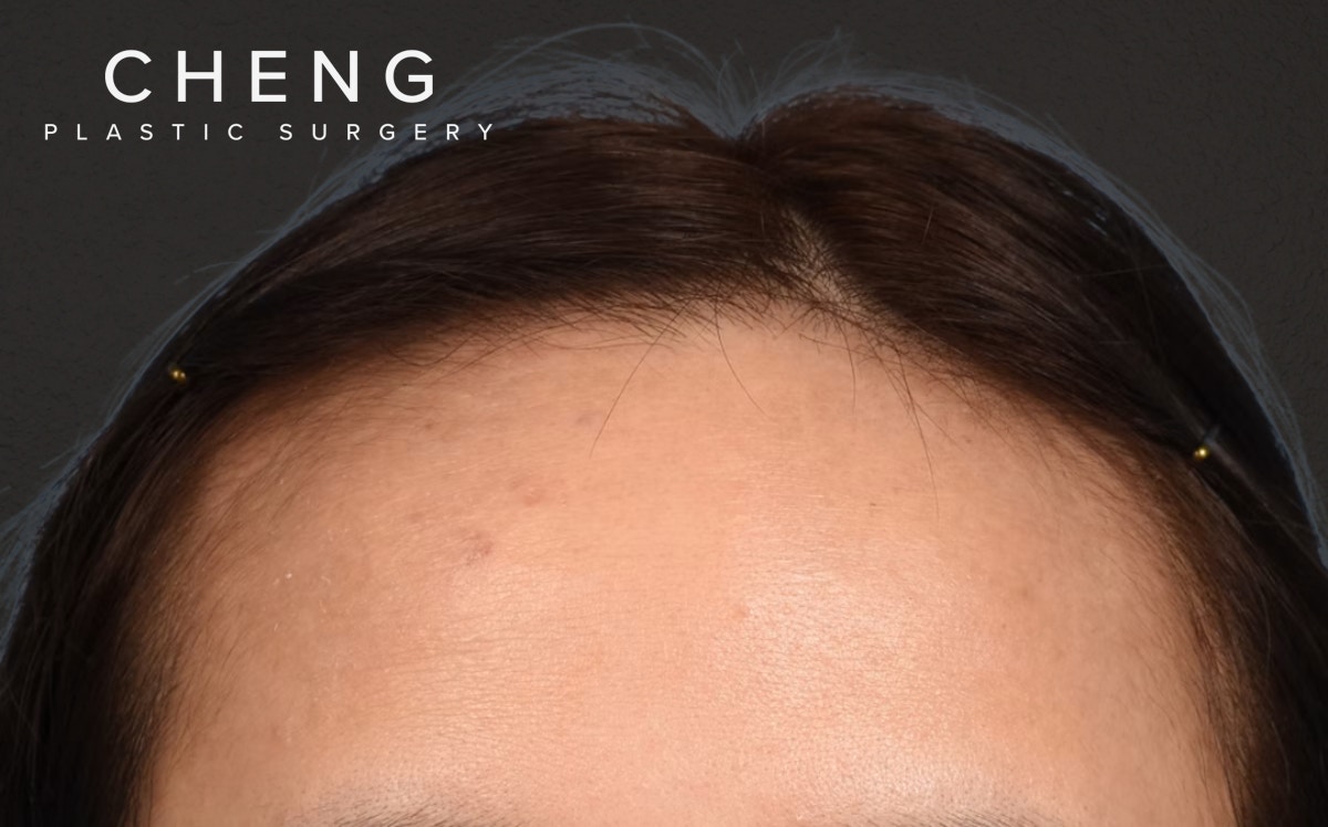 Hair Transplant With NeoGraft Before & After Gallery - Patient 984625 - Image 1