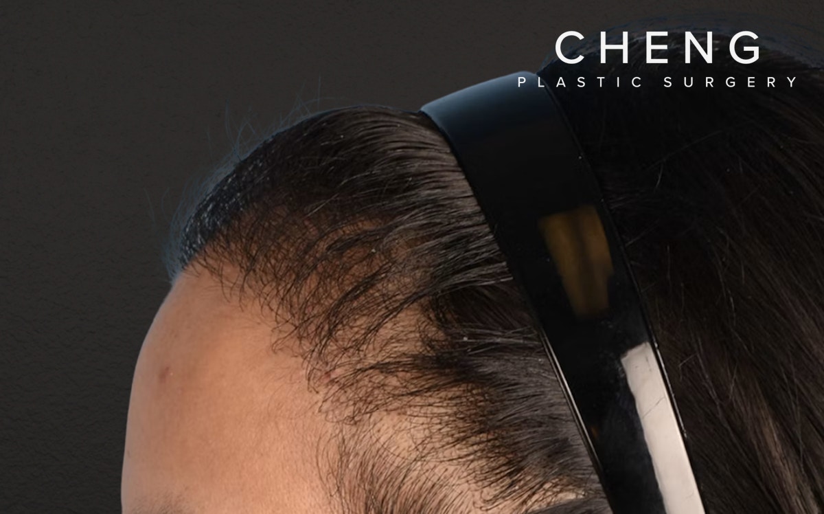Hair Transplant With NeoGraft Before & After Gallery - Patient 984625 - Image 8