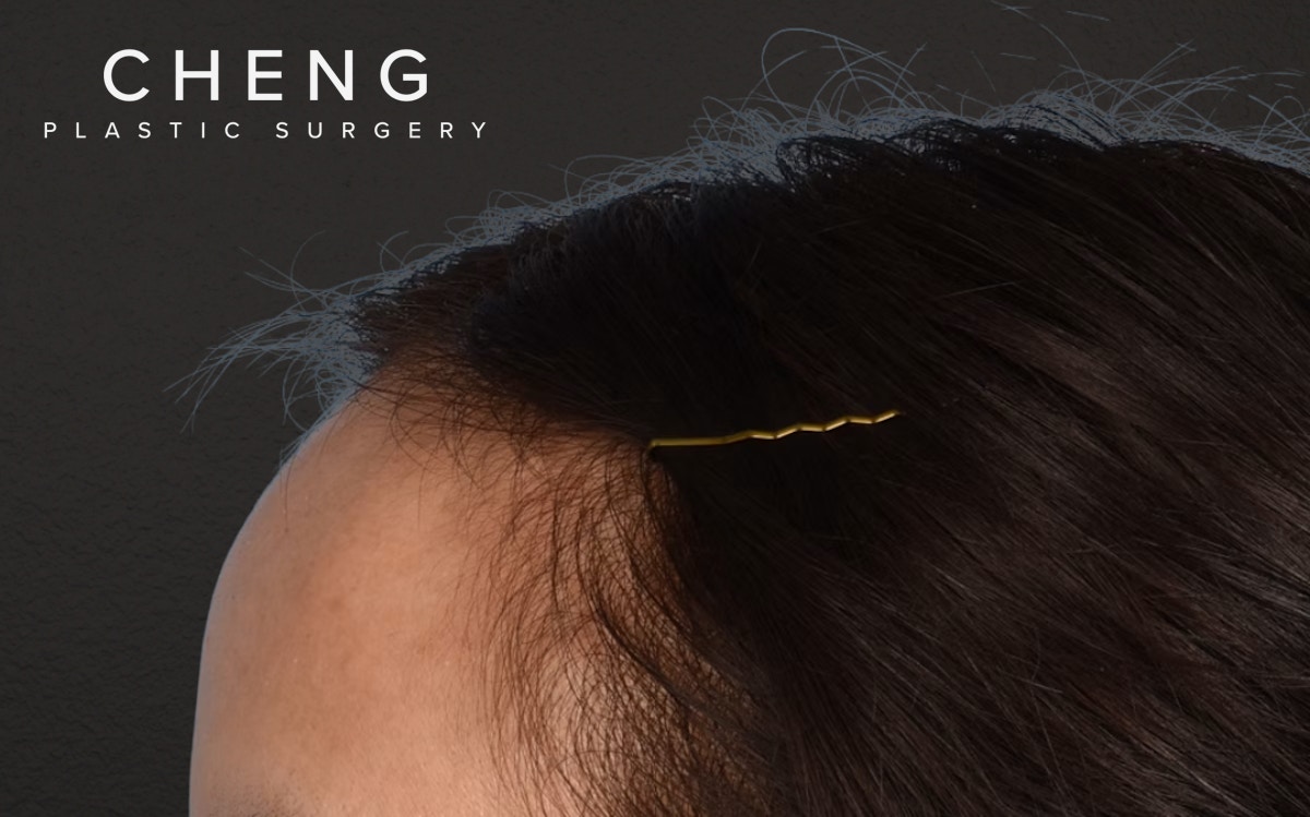 Hair Transplant With NeoGraft Before & After Gallery - Patient 984625 - Image 7