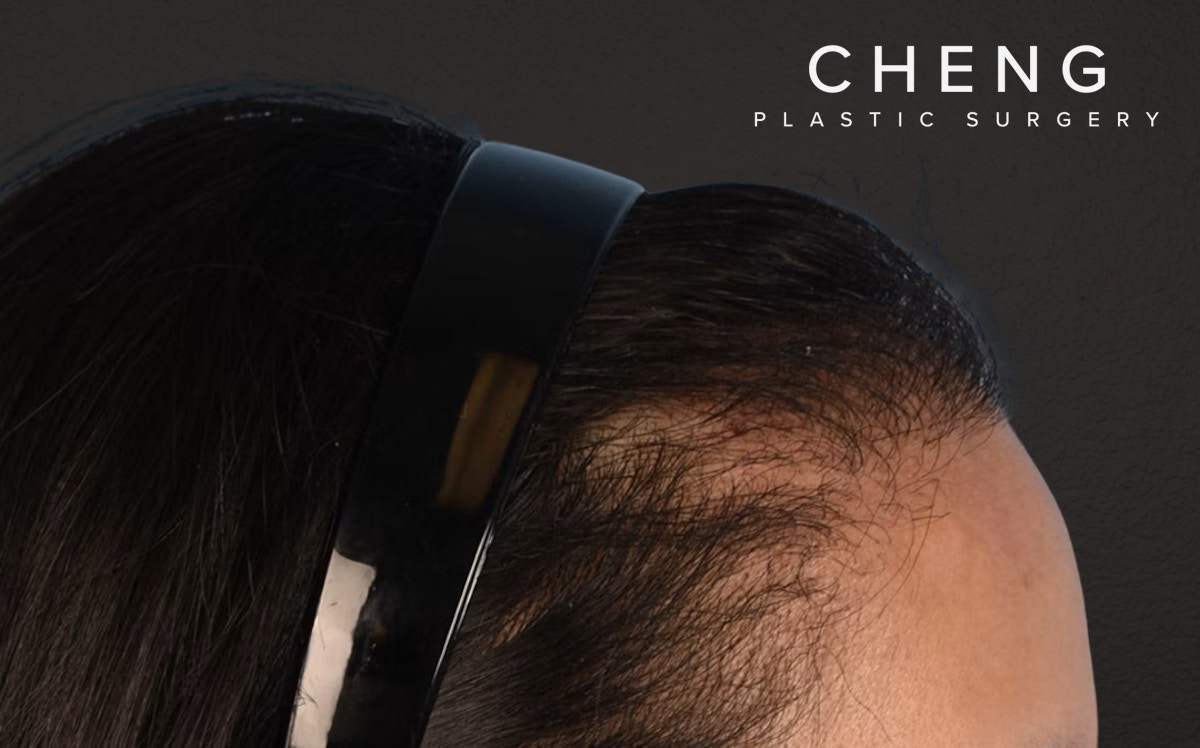 Hair Transplant With NeoGraft Before & After Gallery - Patient 984625 - Image 6