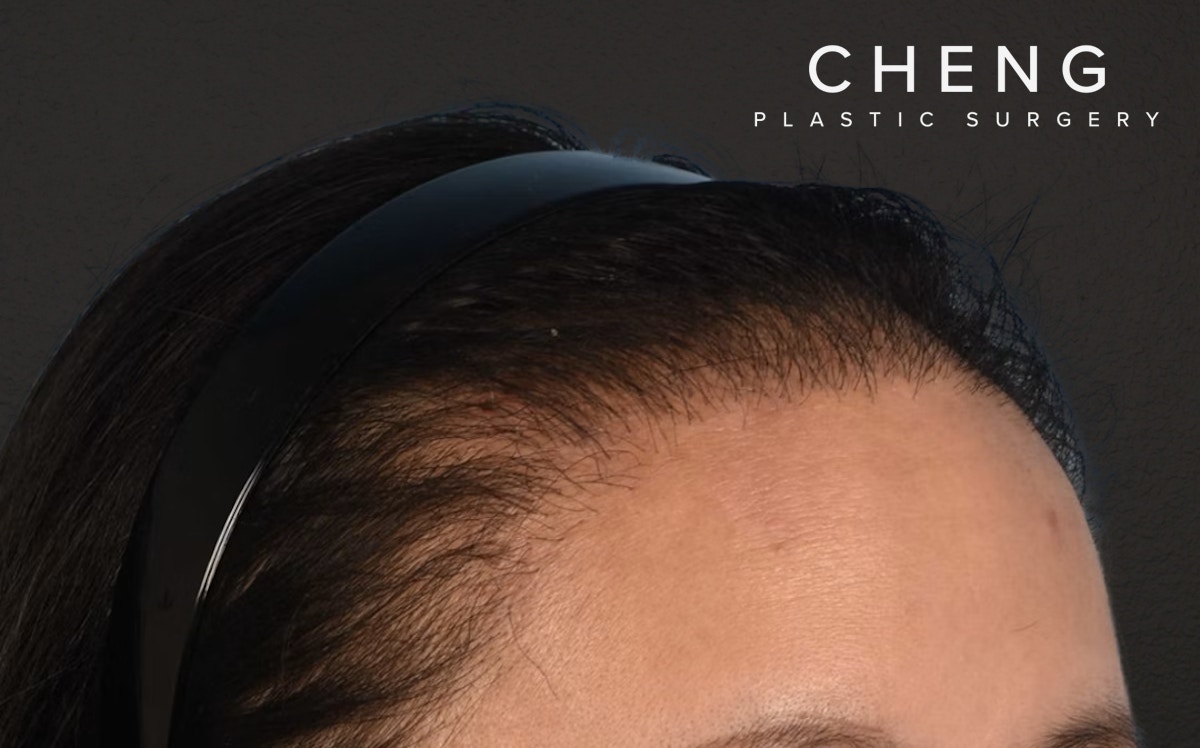 Hair Transplant With NeoGraft Before & After Gallery - Patient 984625 - Image 4