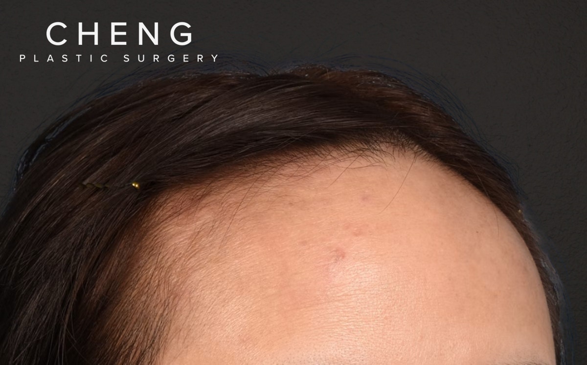 Hair Transplant With NeoGraft Before & After Gallery - Patient 984625 - Image 3