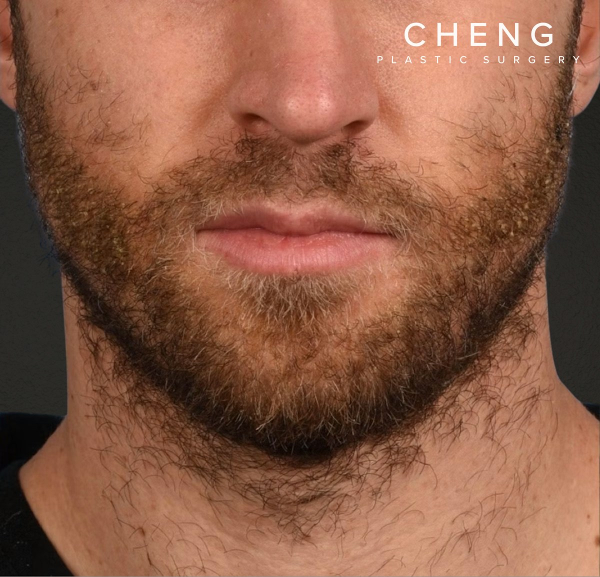 Hair Transplant With NeoGraft Before & After Gallery - Patient 326874 - Image 2
