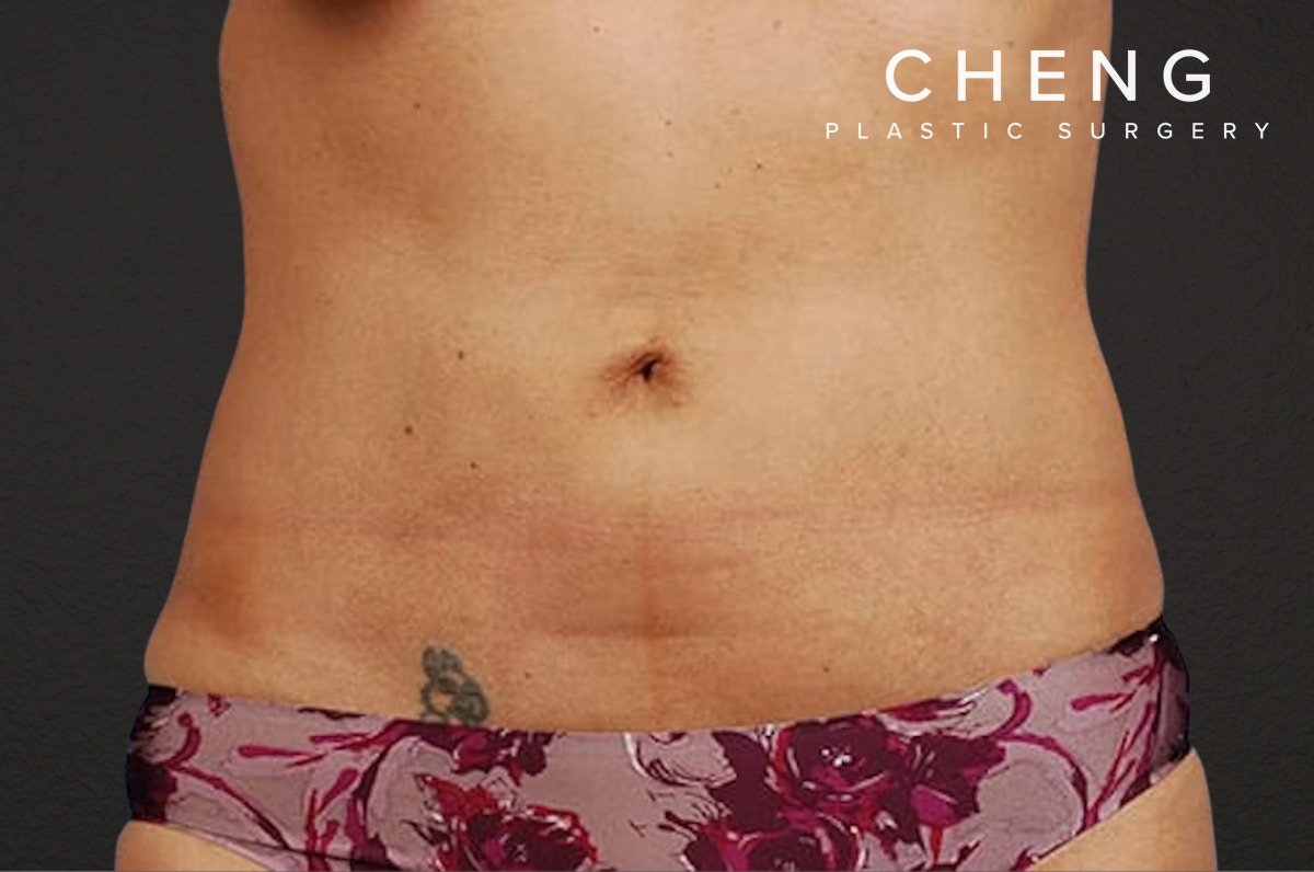 Liposuction Before & After Gallery - Patient 290094 - Image 2