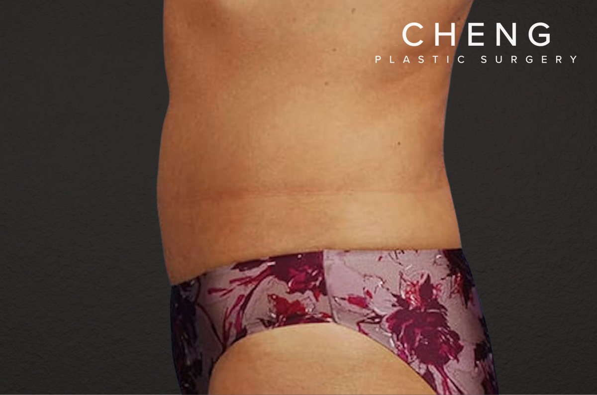 Liposuction Before & After Gallery - Patient 290094 - Image 6