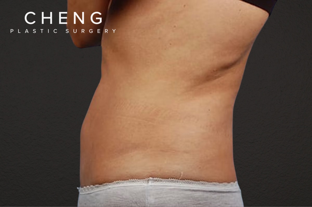 Liposuction Before & After Gallery - Patient 290094 - Image 5