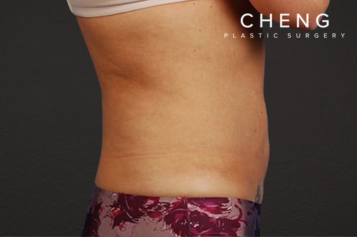 Liposuction Before & After Gallery - Patient 290094 - Image 4