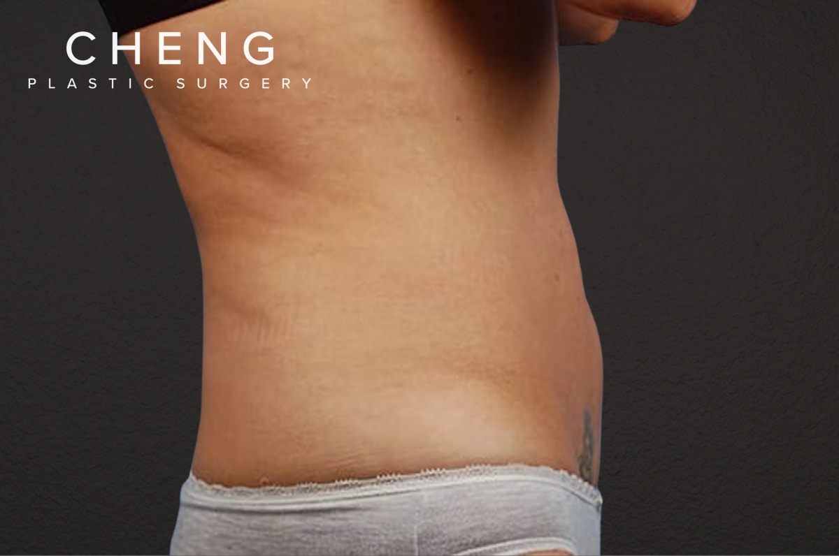 Liposuction Before & After Gallery - Patient 290094 - Image 3