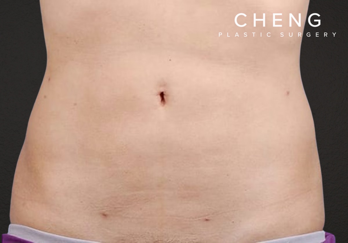 Liposuction Before & After Gallery - Patient 406129 - Image 2