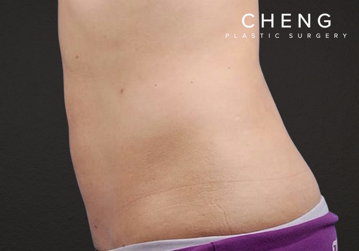 Liposuction Before & After Gallery - Patient 406129 - Image 4