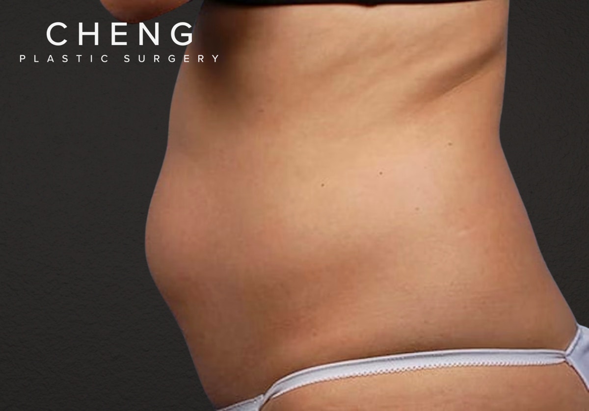Liposuction Before & After Gallery - Patient 406129 - Image 3