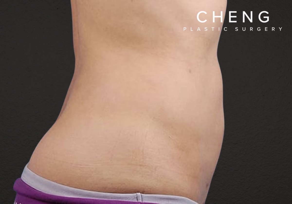 Liposuction Before & After Gallery - Patient 406129 - Image 6