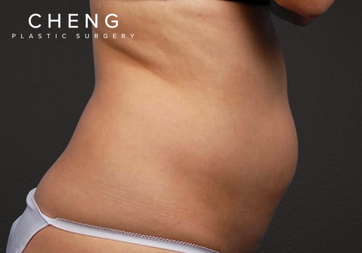 Liposuction Before & After Gallery - Patient 406129 - Image 5
