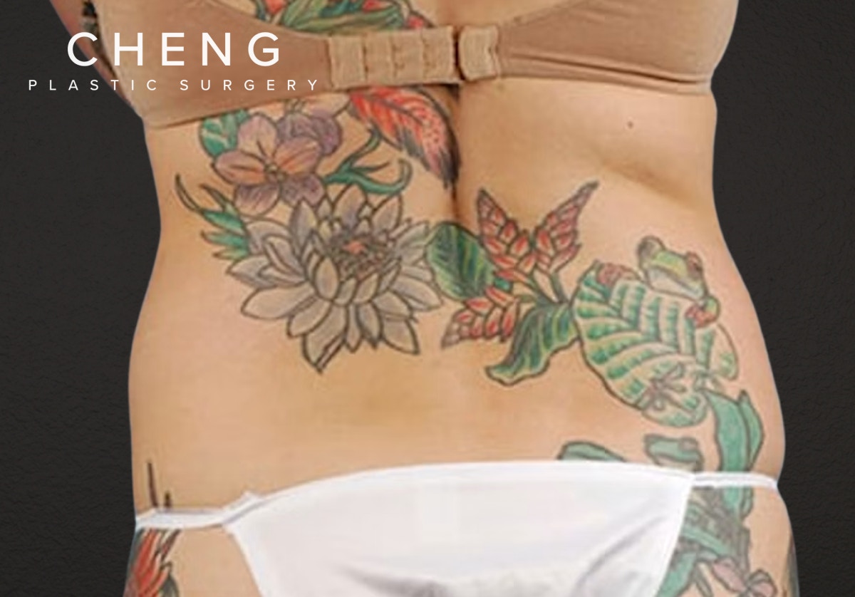 Liposuction Before & After Gallery - Patient 301902 - Image 7