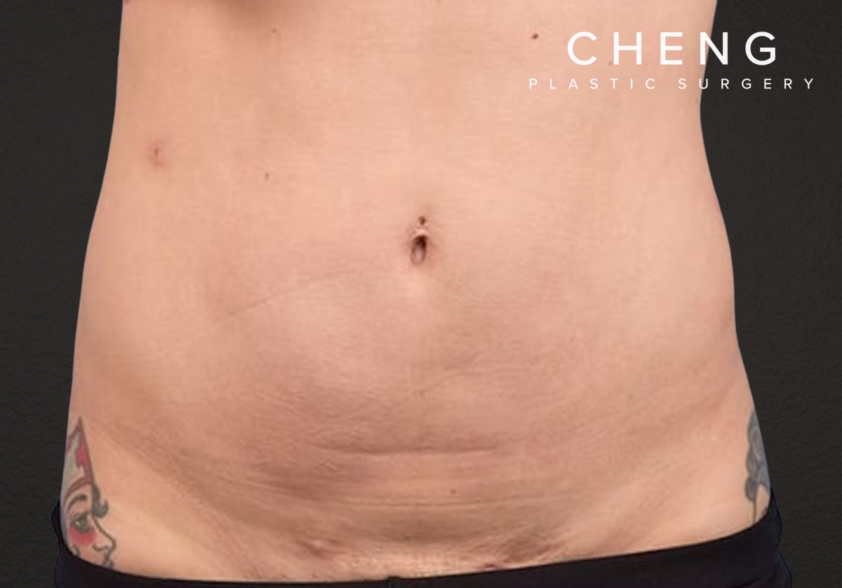 Liposuction Before & After Gallery - Patient 301902 - Image 2