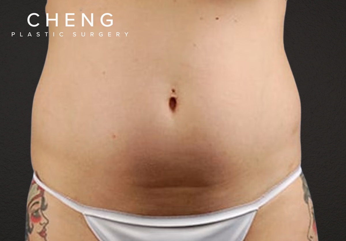 Liposuction Before & After Gallery - Patient 301902 - Image 1