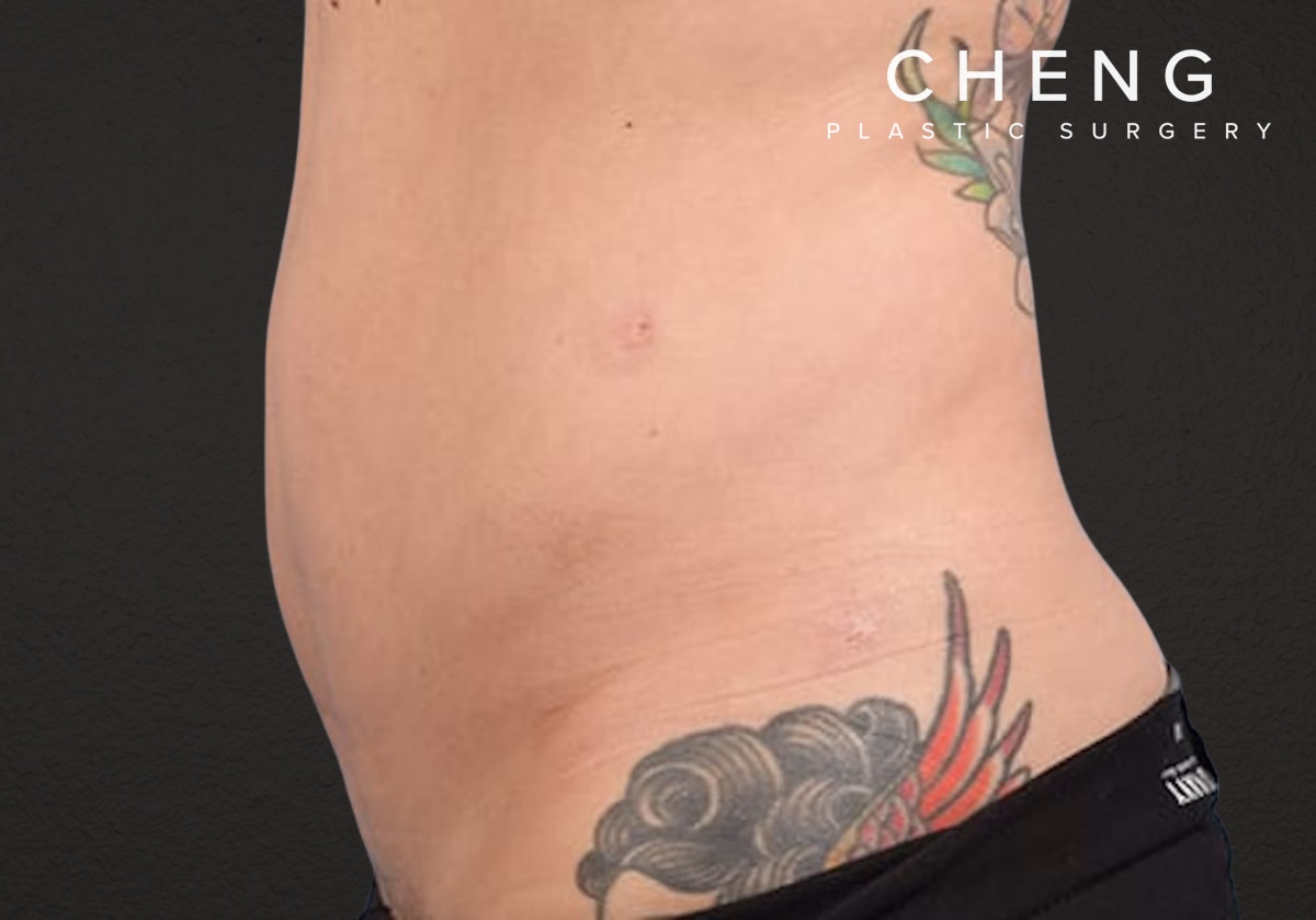 Liposuction Before & After Gallery - Patient 301902 - Image 4