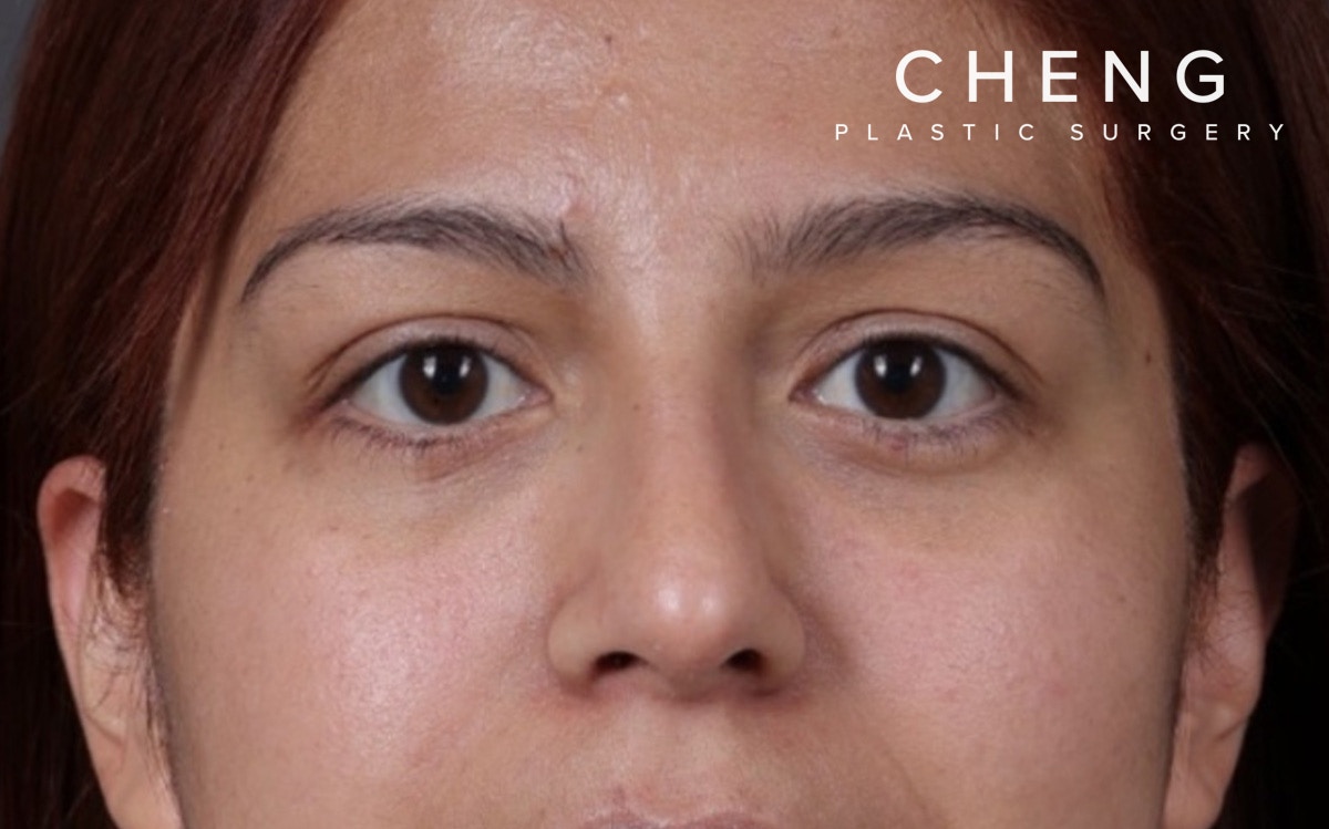 Blepharoplasty Before & After Gallery - Patient 228493 - Image 2