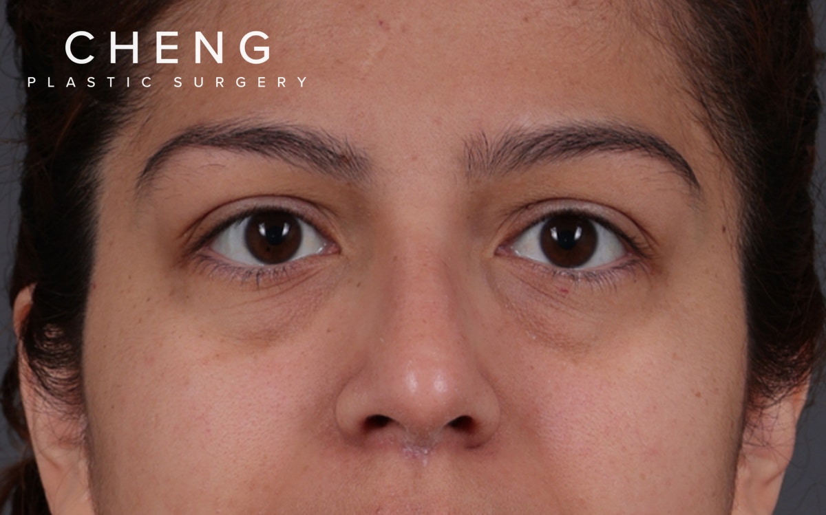 Blepharoplasty Before & After Gallery - Patient 228493 - Image 1
