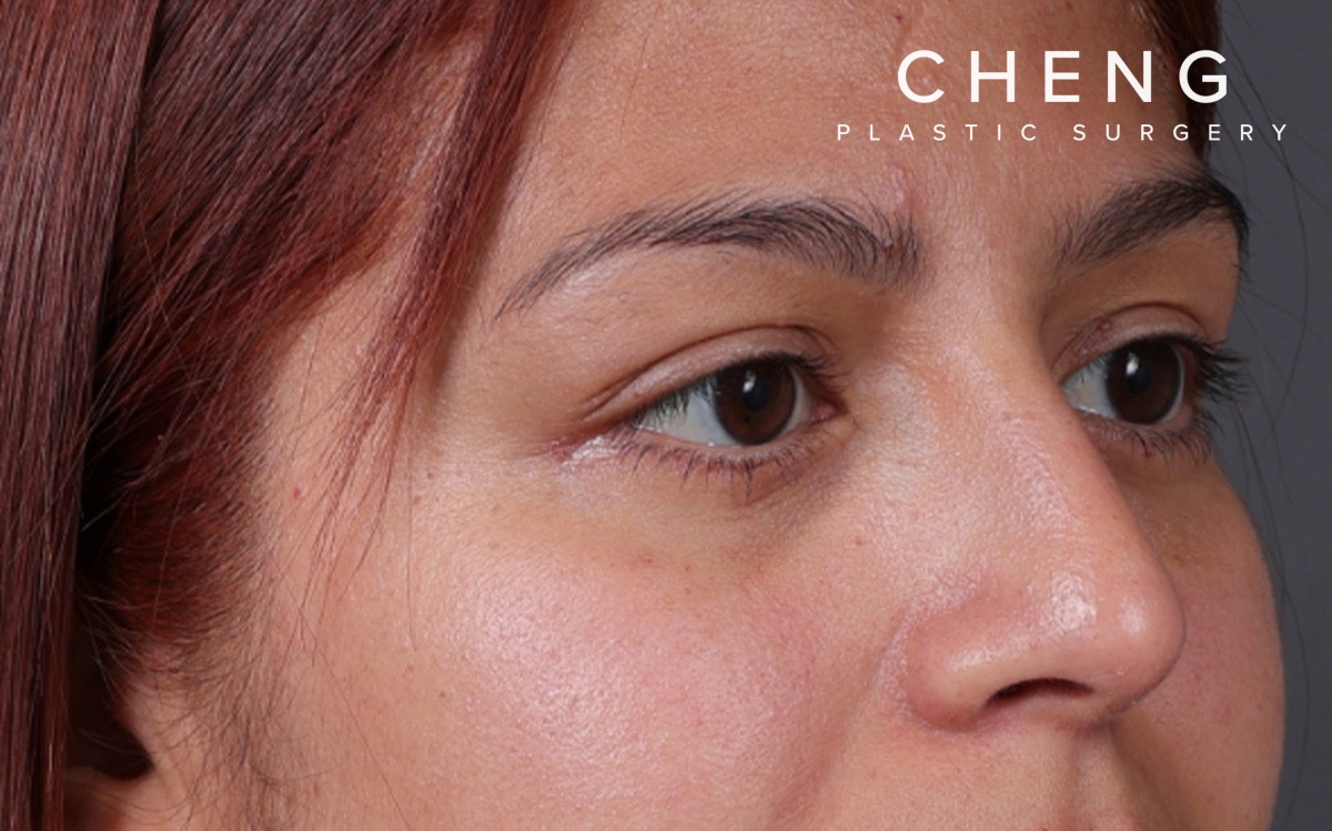 Blepharoplasty Before & After Gallery - Patient 228493 - Image 4